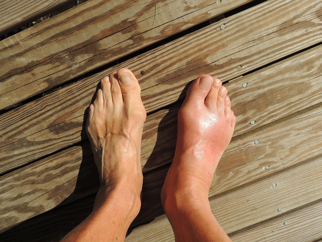 Gout Treatment in  Seattle, WA 